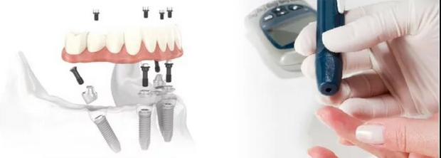 Возможна ли имплантация зубов при сахарном диабете?