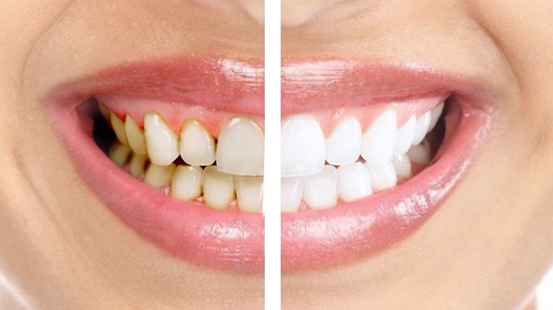 Важность проведения профессиональной чистки зубов