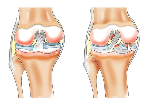 Лечение мениска коленного сустава