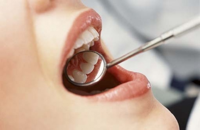 Отбеливание зубов: правда и вымысел